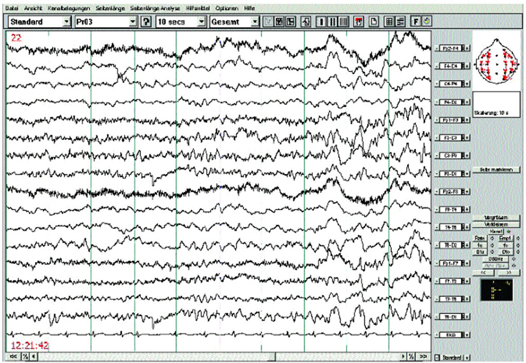 Eeg Auffällig Aber Keine Anfälle