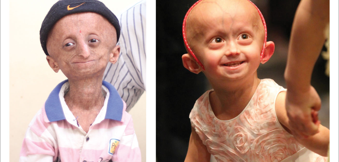 Ursachen für Progerie in Wien aufgeklärt MedMix