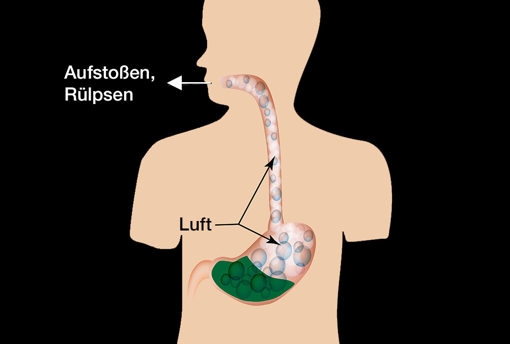 Luft im Magen einfach begegnen MedMix