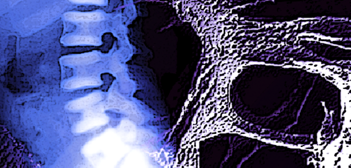 Frühe OsteoporoseDiagnose durch Knochendichtemessung MedMix