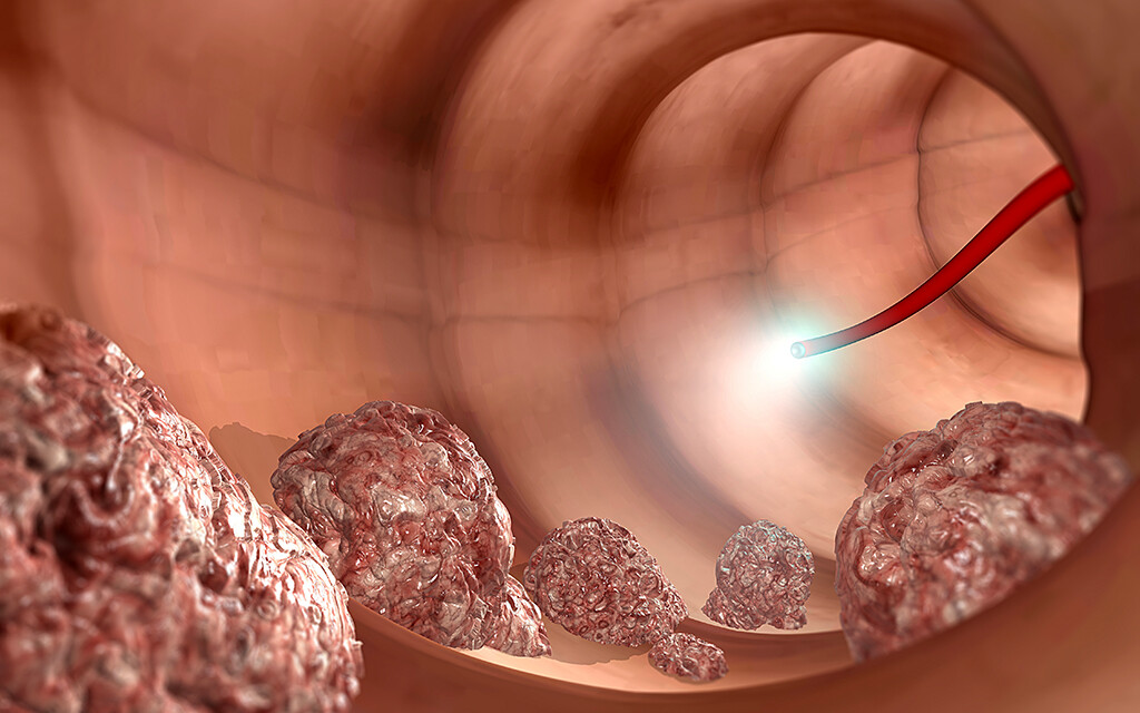 gegen Darmkrebs MedMix