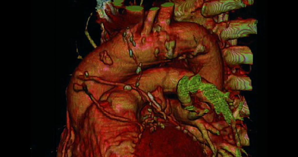 Wie Rauchen Herz und Kreislauf beeinflussen MedMix