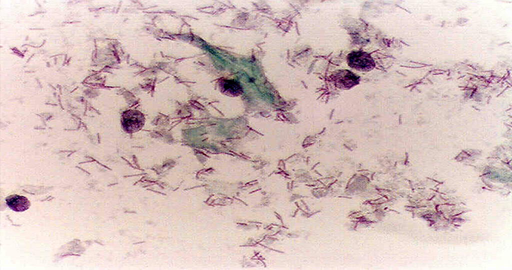 Gesunde Scheidenflora mit Milchsäurebakterien besiedelt MedMix