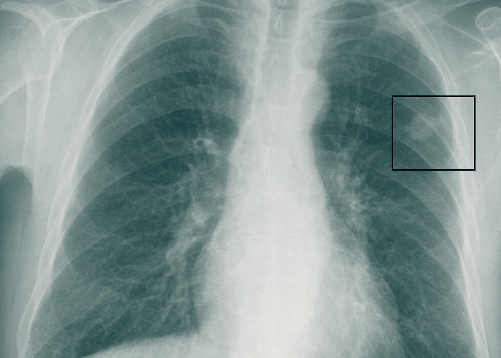 Neues Konzept für Strahlentherapie bei Lungenkrebs