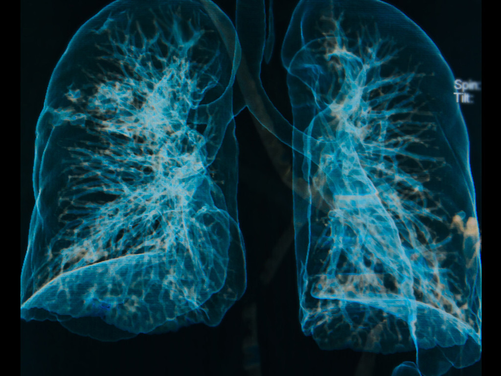 Exazerbation bei COPD ist eine plötzliche deutliche Verschlechterung im Verlauf der COPD-Erkrankung innerhalb eines kurzen Zeitraums. © Praisaeng / shutterstock.com