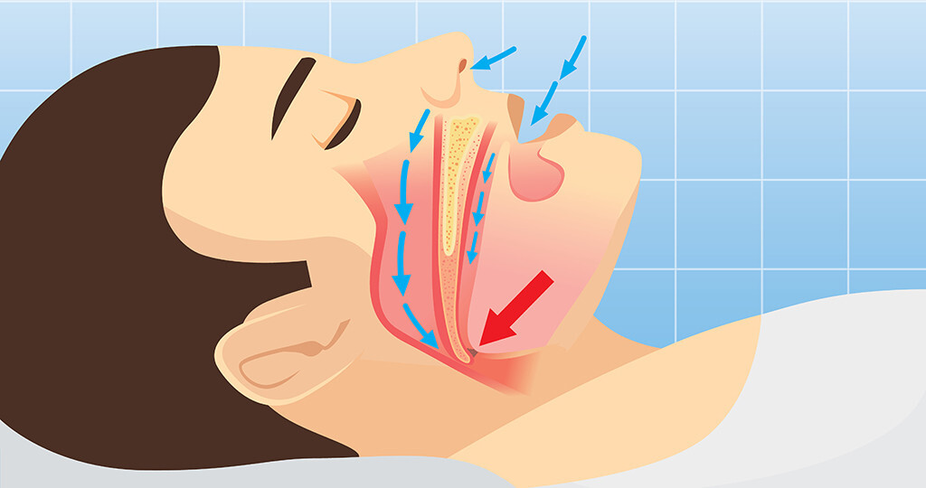 Schnarchen Ist Gefahrlich Obstruktive Schlafapnoe Und Herzinsuffizienz
