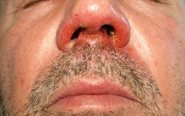 Impetigo contagiosa Haut und Weichteilinfektionen MedMix