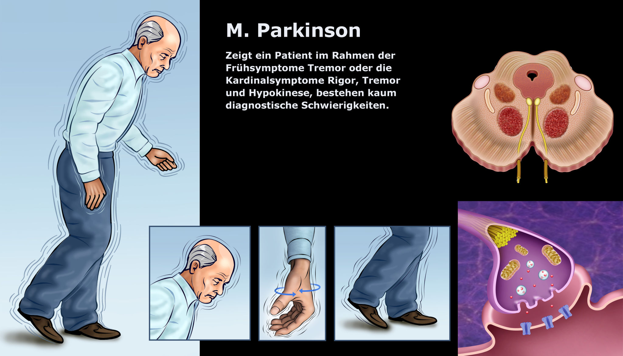 Parkinson Wie Fängt Es An www.medmix.at