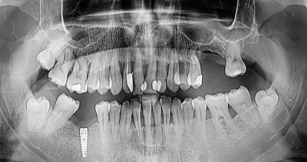 Parodontitis durch Rauchen ein zentraler Risikofaktor
