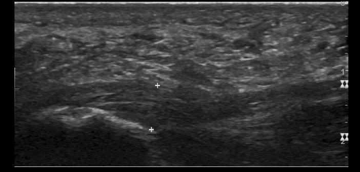 Volkskrankheit Plantarfasziitis - MedMix