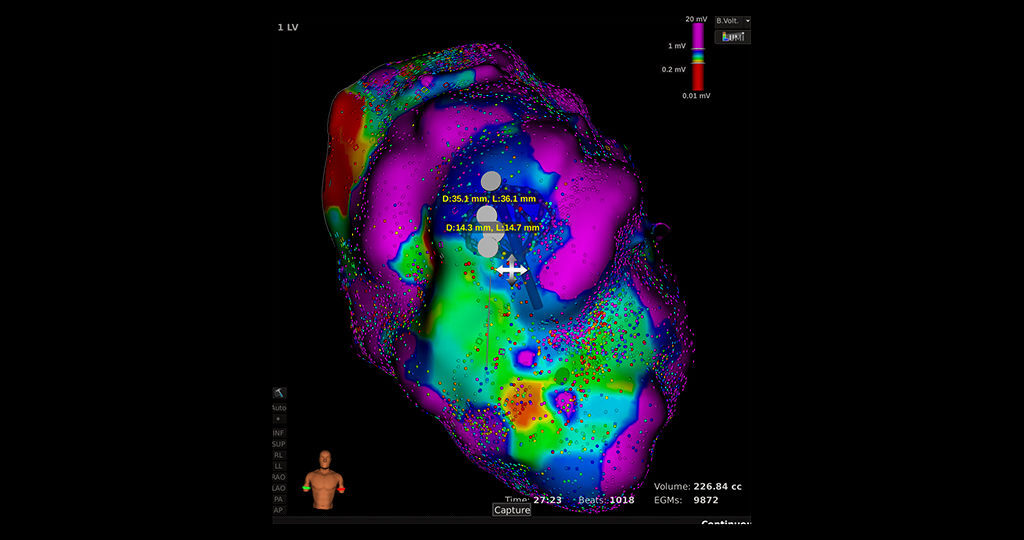 Abbildung 1: Mithilfe eines der weltweit modernsten Mappingsysteme wurde aus mehr als 10.000 Datenpunkten eine hochauflösende Darstellung der linken Herzkammer im elektrophysiologischen Labor erstellt, um so die Zielregion für die Bestrahlung zu identifizieren. © Universitätsklinikum Schleswig-Holstein