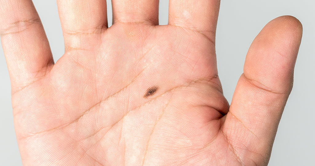 Melanozytäre Läsionen zeigen dermatoskopisch oft untypisch