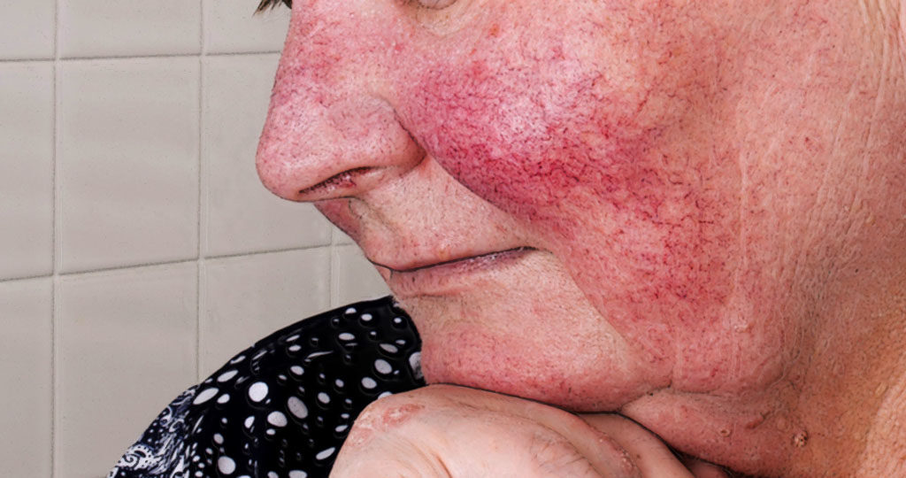 Die Hautkrankheit Rosacea Fr h Erkennen Und Wirksam Behandeln
